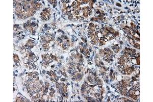 Immunohistochemical staining of paraffin-embedded Carcinoma of liver tissue using anti-LIPG mouse monoclonal antibody. (LIPG antibody)