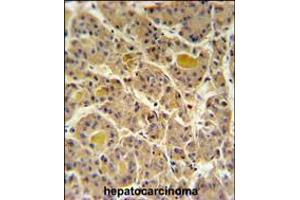 IN80D Antibody IHC analysis in formalin fixed and paraffin embedded human hepatocarcinoma followed by peroxidase conjugation of the secondary antibody and DAB staining. (IN80D antibody  (N-Term))