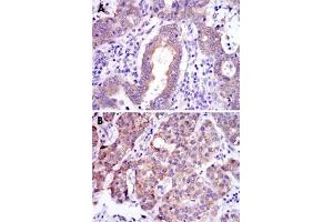 Immunohistochemical analysis of paraffin-embedded human endometrial cancer tissues (A) and liver cancer tissues (B) using REL monoclonal antibody, clone 1E7  with DAB staining.
