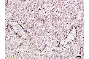 Formalin-fixed and paraffin embedded human cervical carcinoma labeled Anti-FGFR4 Polyclonal Antibody, Unconjugated (ABIN671766) at 1:200, followed by conjugation to the secondary antibody and DAB staining (FGFR4 antibody  (AA 1-100))
