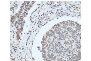 Immunohistochemistry of paraffin-embedded Human lung cancer using ZNF433 Polyclonal Antibody at dilution of 1:100 (40x lens). (ZNF433 antibody)