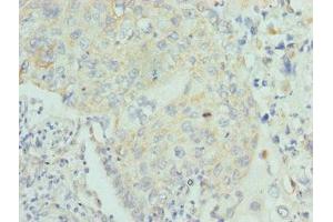 Immunohistochemistry of paraffin-embedded human lung cancer using ABIN7158582 at dilution of 1:100 (LUM antibody  (AA 19-338))