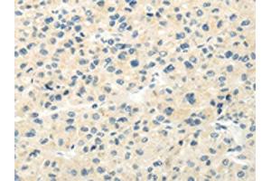 The image on the left is immunohistochemistry of paraffin-embedded Human liver cancer tissue using ABIN7193018(VIPR1 Antibody) at dilution 1/20, on the right is treated with synthetic peptide. (VIPR1 antibody)