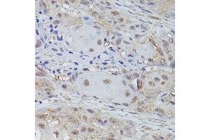 Immunohistochemistry of paraffin-embedded human esophageal cancer using TET3 Rabbit pAb (ABIN6133174, ABIN6149021, ABIN6149023 and ABIN6223527) at dilution of 1:150 (40x lens).