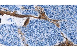 Immunohistochemistry of paraffin-embedded Human lung cancer tissue using COL3A1 Polyclonal Antibody at dilution 1:60 (COL3A1 antibody)