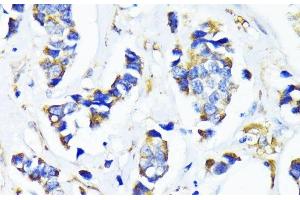 Immunohistochemistry of paraffin-embedded Human breast cancer using MRPL45 Polyclonal Antibody at dilution of 1:100 (40x lens). (MRPL45 antibody)