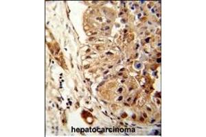 Formalin-fixed and paraffin-embedded human hepatocarcinoma reacted with ATLA2 Antibody (Center), which was peroxidase-conjugated to the secondary antibody, followed by DAB staining. (Atlastin-2 antibody  (AA 297-326))