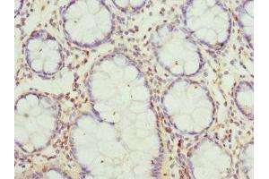 Immunohistochemistry of paraffin-embedded human colon cancer using ABIN7160702 at dilution of 1:100 (GCNT2 antibody  (AA 203-402))