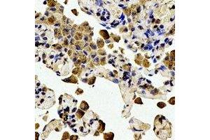 Immunohistochemical analysis of BCL2 (pT56) staining in human lung cancer formalin fixed paraffin embedded tissue section. (Bcl-2 antibody  (pSer56))