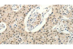 Immunohistochemistry of paraffin-embedded Human lung cancer tissue using Frizzled 10 Polyclonal Antibody at dilution 1:50 (FZD10 antibody)