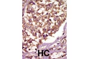 Formalin-fixed and paraffin-embedded human cancer tissue reacted with the primary antibody, which was peroxidase-conjugated to the secondary antibody, followed by AEC staining. (BMX antibody  (AA 212-242))