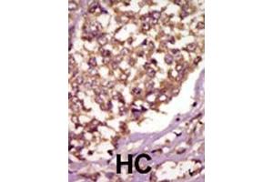 Formalin-fixed and paraffin-embedded human cancer tissue reacted with the primary antibody, which was peroxidase-conjugated to the secondary antibody, followed by AEC staining. (BMX antibody  (AA 212-242))