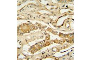 Immunohistochemistry analysis in formalin fixed and paraffin embedded human lung tissue reacted with NDUF3 Antibody (N-term) followed which was peroxidase conjugated to the secondary antibody and  followed by DAB staining.