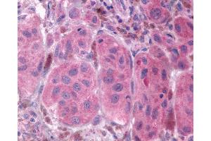 Anti-FP / PTGFR antibody IHC of human Skin, Melanoma. (PTGFR antibody  (Extracellular Domain))