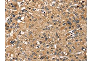The image on the left is immunohistochemistry of paraffin-embedded Human liver cancer tissue using ABIN7191289(LONP1 Antibody) at dilution 1/25, on the right is treated with synthetic peptide. (LONP1 antibody)