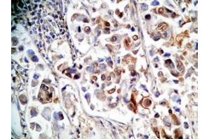Human stomach cancer tissue was stained by rabbit anti-Spexin(H) Antiserum (Spexin antibody)