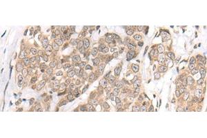 Immunohistochemistry of paraffin-embedded Human thyroid cancer tissue using M1AP Polyclonal Antibody at dilution of 1:80(x200)