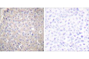 Peptide - +Immunohistochemical analysis of paraffin-embedded human breast carcinoma tissue using E-cadherin antibody. (E-cadherin antibody)