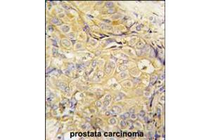 Formalin-fixed and paraffin-embedded human prostata carcinoma tissue reacted with FGF10 antibody , which was peroxidase-conjugated to the secondary antibody, followed by DAB staining. (FGF10 antibody  (C-Term))