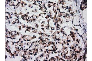 Immunohistochemical staining of paraffin-embedded Adenocarcinoma of Human colon tissue using anti-FAM127C mouse monoclonal antibody. (FAM127C antibody)