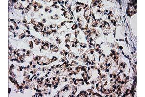 Immunohistochemical staining of paraffin-embedded Adenocarcinoma of Human colon tissue using anti-FAM127C mouse monoclonal antibody. (FAM127C antibody)