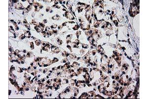 Immunohistochemical staining of paraffin-embedded Adenocarcinoma of Human colon tissue using anti-FAM127C mouse monoclonal antibody.