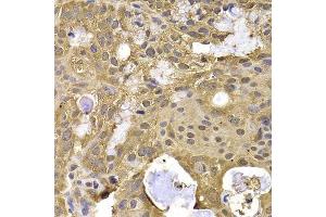 Immunohistochemistry of paraffin-embedded human oophoroma using NAA20 antibody. (NAT5 antibody  (AA 49-178))