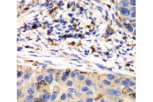 Immunohistochemistry of paraffin-embedded Human esophageal cancer using S100A8 Polyclonal Antibody at dilution of 1:100 (40x lens). (S100A8 antibody)