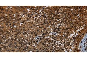 Immunohistochemistry of paraffin-embedded Human cervical cancer tissue using KDM4B Polyclonal Antibody at dilution 1:50 (KDM4B antibody)