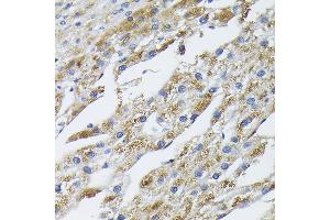 Immunohistochemistry of paraffin-embedded human liver cancer using BMP2 Rabbit pAb (ABIN3020733, ABIN3020734, ABIN1512642, ABIN1513827 and ABIN6213697) at dilution of 1:100 (40x lens). (BMP2 antibody  (AA 283-396))