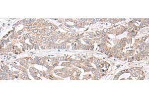 Immunohistochemistry of paraffin-embedded Human liver cancer tissue using CHST4 Polyclonal Antibody at dilution of 1:35(x200)