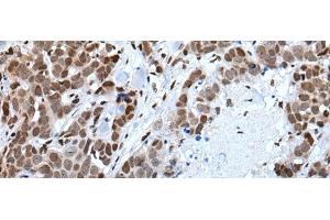 Immunohistochemistry of paraffin-embedded Human thyroid cancer tissue using CELF5 Polyclonal Antibody at dilution of 1:65(x200)
