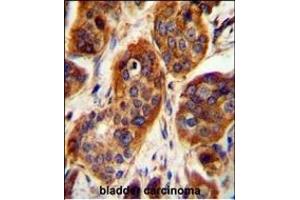 LRRC57 Antibody (C-term) (ABIN654494 and ABIN2844226) immunohistochemistry analysis in formalin fixed and paraffin embedded human bladder carcinoma followed by peroxidase conjugation of the secondary antibody and DAB staining. (LRRC57 antibody  (C-Term))