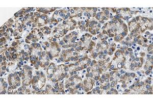 ABIN6274573 at 1/100 staining Human liver cancer tissue by IHC-P.