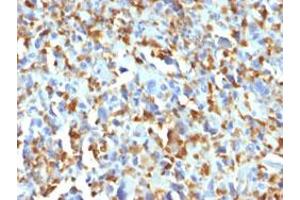 Immunohistochemical staining (Formalin-fixed paraffin-embedded sections) of human histiocytoma with F13A1 monoclonal antibody, clone F13A1/1683 .