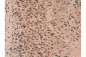 Detection of RORg in Human Lung Cancer Tissue using Polyclonal Antibody to RAR Related Orphan Receptor Gamma (RORg) (RORC antibody  (AA 212-461))