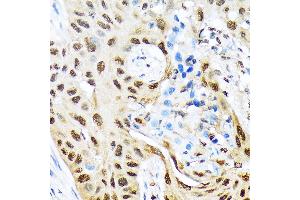 Immunohistochemistry of paraffin-embedded human lung cancer using HES5 Rabbit mAb (ABIN7267559) at dilution of 1:100 (40x lens). (HES5 antibody)