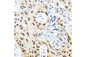 Immunohistochemistry of paraffin-embedded human lung cancer using HES5 Rabbit mAb (ABIN7267559) at dilution of 1:100 (40x lens).