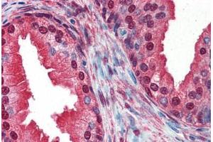 Human Prostate (formalin-fixed, paraffin-embedded) stained with COPS5 antibody ABIN337275 at 10 ug/ml followed by biotinylated anti-mouse IgG secondary antibody ABIN481714, alkaline phosphatase-streptavidin and chromogen. (COPS5 antibody  (Internal Region))