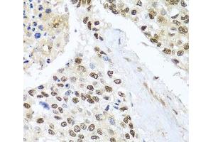 Immunohistochemistry of paraffin-embedded Human lung cancer using BNIP3L Polyclonal Antibody at dilution of 1:100 (40x lens). (BNIP3L/NIX antibody)