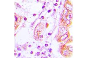Immunohistochemical analysis of iNOS staining in human lung cancer formalin fixed paraffin embedded tissue section. (NOS2 antibody  (C-Term))