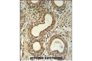 Roundabout 4 Antibody (N-term) (ABIN651292 and ABIN2840173) IHC analysis in formalin fixed and paraffin embedded prostate carcinoma followed by peroxidase conjugation of the secondary antibody and DAB staining. (ROBO4 antibody  (N-Term))