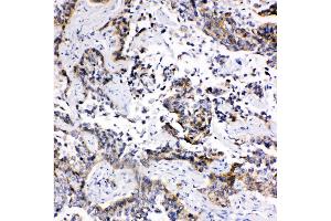 Anti-MRP1 antibody, IHC(P) IHC(P): Human Lung Cancer Tissue (ABCC1 antibody  (C-Term))