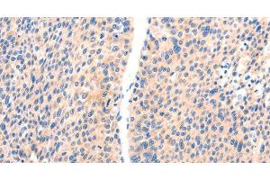 Immunohistochemistry of paraffin-embedded Human liver cancer using PAFAH2 Polyclonal Antibody at dilution of 1:80 (PAFAH2 antibody)