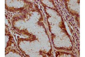 IHC image of ABIN7175232 diluted at 1:100 and staining in paraffin-embedded human gastric cancer performed on a Leica BondTM system. (ATP6V1C1 antibody  (AA 129-382))