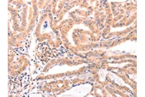 The image on the left is immunohistochemistry of paraffin-embedded Human thyroid cancer tissue using ABIN7129152(DAZ4 Antibody) at dilution 1/50, on the right is treated with fusion protein. (DAZ4 antibody)