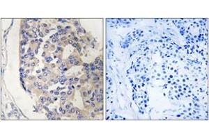Immunohistochemistry analysis of paraffin-embedded human breast carcinoma tissue, using C1S Antibody.