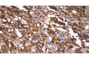 Immunohistochemistry of paraffin-embedded Human thyroid cancer tissue using GREB1 Polyclonal Antibody at dilution 1:40 (GREB1 antibody)