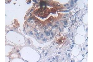 Detection of DEFa3 in Human Colorectal cancer Tissue using Polyclonal Antibody to Defensin Alpha 3, Neutrophil Specific (DEFa3) (DEFa3 antibody  (AA 21-94))