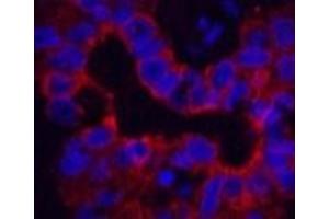 Immunofluorescence analysis of Human liver cancer tissue using CK-16 Monoclonal Antibody at dilution of 1:200. (KRT16 antibody)
